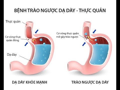 Bệnh trào ngược dạ dày thực quản có nguy hiểm không?