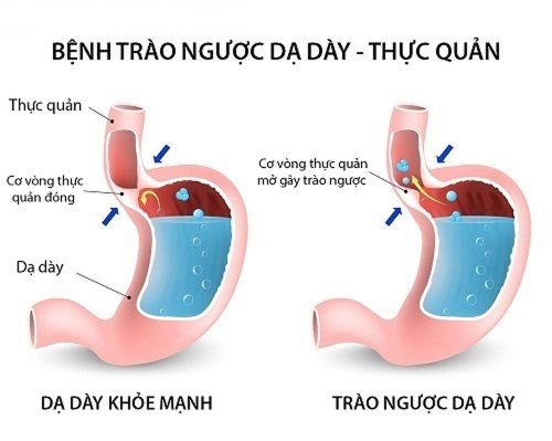 Trào ngược dạ dày là gì?