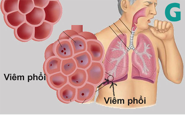 Triệu chứng viêm phổi