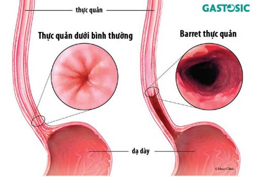 barret thực quản