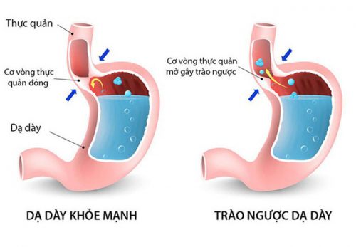 Trào ngược dạ dày ngày càng phổ biến trong cuộc sống