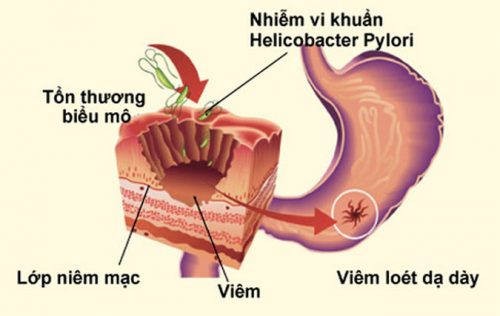 Viêm loét dạ dày