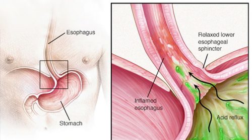 Hình ảnh bệnh trào ngược dạ dày