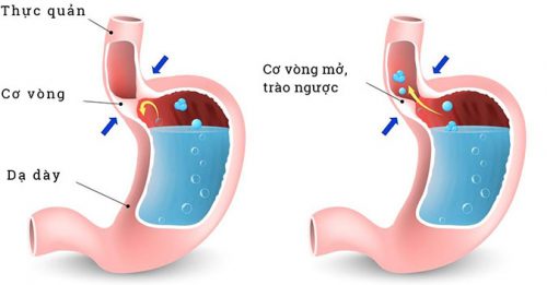Minh họa bệnh trào ngược dạ dày