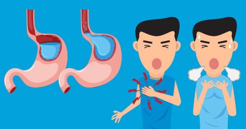 trào ngược dạ dày là bệnh rất phổ biến