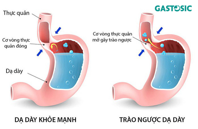 Trào ngược dạ dày nguyên nhân phổ biến gây ăn không tiêu ợ chua