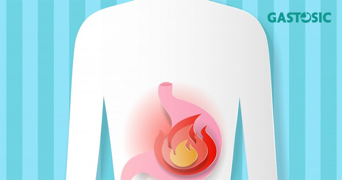 Trào ngược dạ dày nguyên nhân phổ biến nhất gây ra chứng ợ hơi kéo dài.