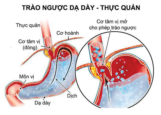 Trào ngược dạ dày thực quản nguyên nhân gây ợ nóng nôn ra máu
