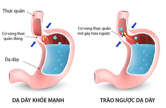 Nguyên nhân gây ợ nóng nôn ra máu là do trào ngược dạ dày
