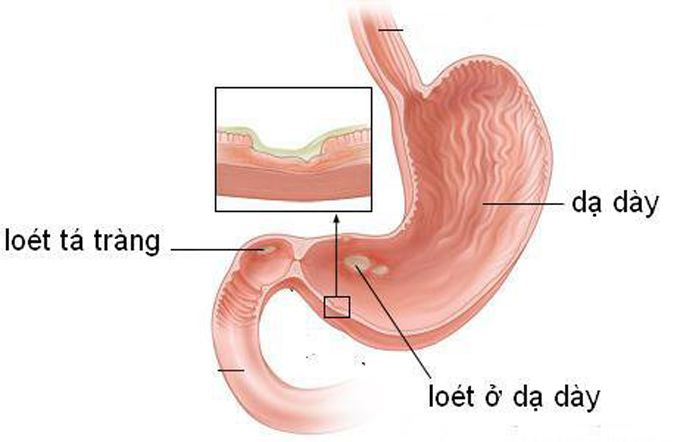 Viêm dạ dày nguyên nhân gây ợ nóng nôn ra máu
