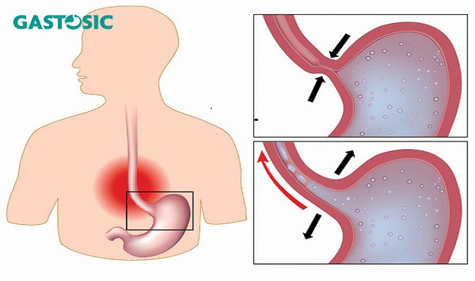 Bệnh trào ngược dạ dày thực quản