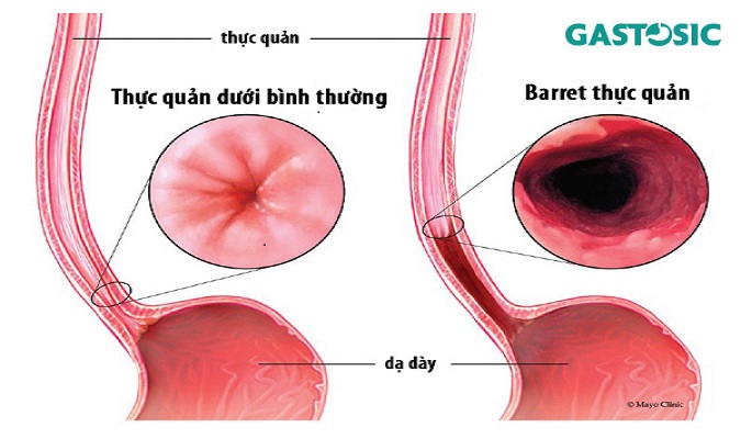 Barrett thực quản