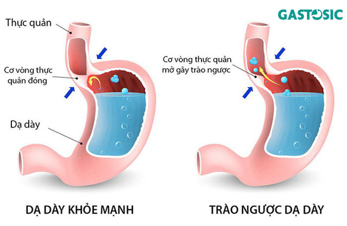 Hình ảnh trào ngược dạ dày
