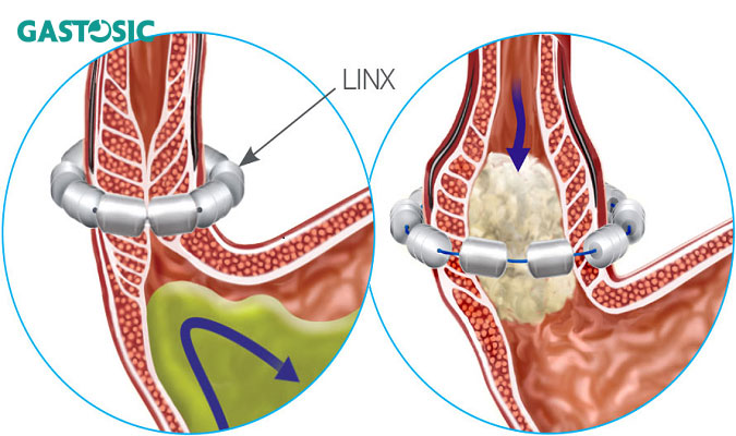 Phẫu thuật để tăng cường cơ vòng thực quản dưới Linx