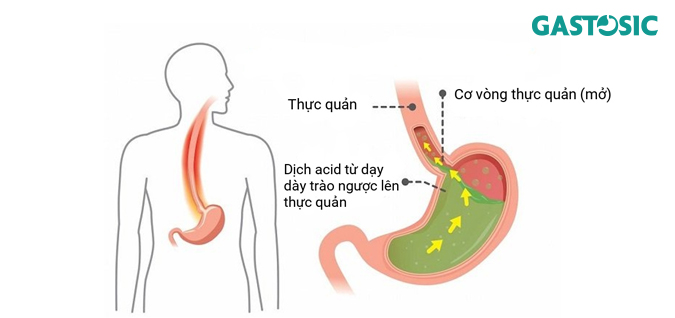 Trào ngược dạ dày gây bệnh lý ợ chua buồn nôn