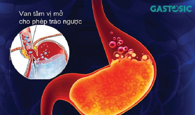 Các cấp độ của trào ngược dạ dày