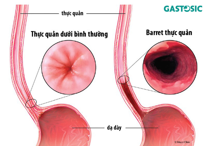 Barrett thực quản triệu chứng nguy hiểm của trào ngược dạ dày 