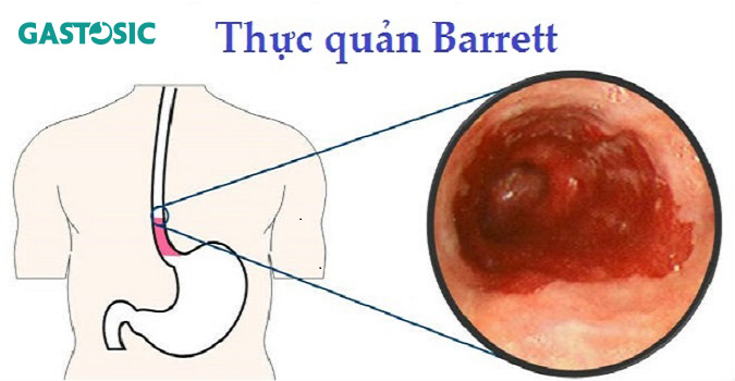 Barrett thực quản