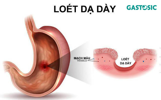 Ợ nóng liên tục dấu hiệu của loét dạ dày