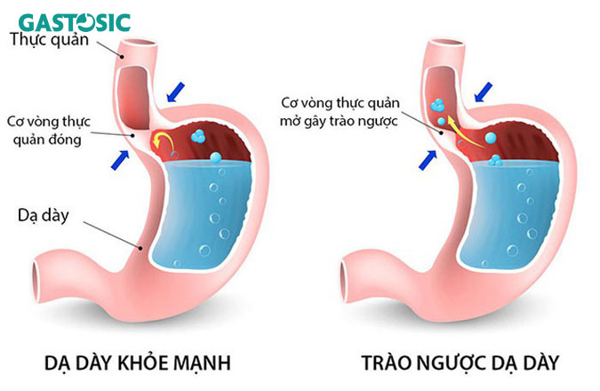 Bệnh trào ngược dạ dày nặng là nguyên nhân trào ngược dạ dày lên mũi 