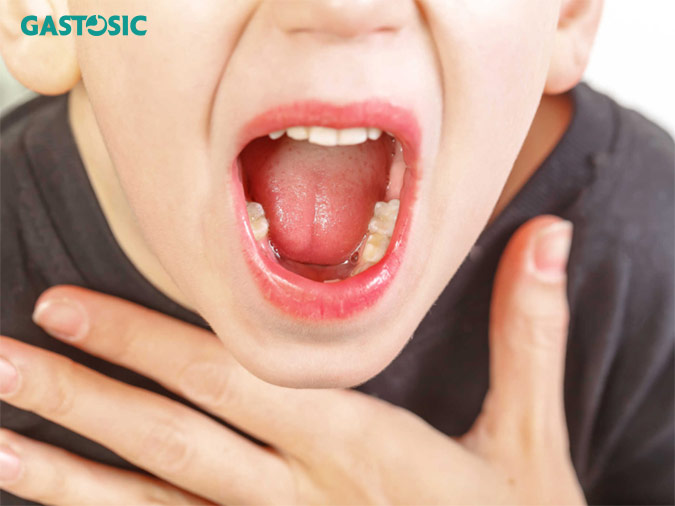 Trào ngược dạ dày gây viêm họng và phù nề họng