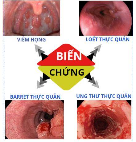 hiểu đúng trào ngược dạ dày