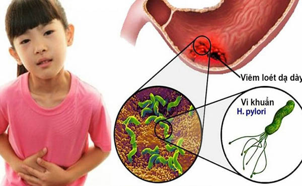 trào ngược dạ dày ở trẻ em có nguy hiểm không