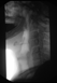Chụp X - quang nội soi huỳnh quang
