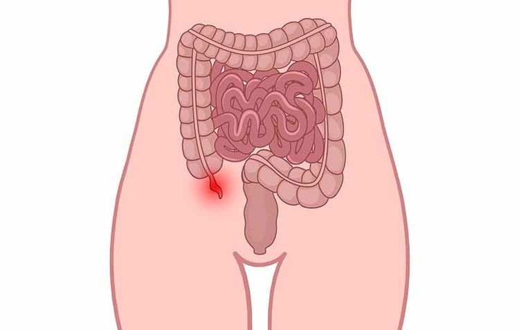 Đau bụng do viêm ruột thừa thường xuất hiện ở phía dưới bên phải