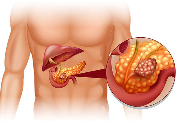 Đau bụng do viêm tụy thường xuất hiện ở phía trên và phía sau bụng, có thể lan ra vùng lưng và vai